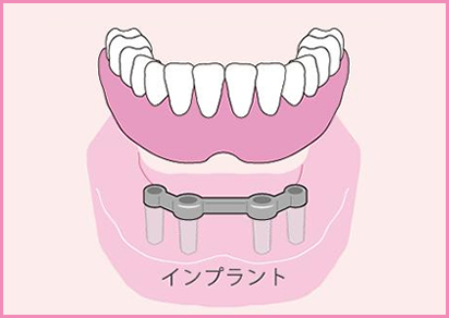 奥歯が全部抜けた場合のインプラントによる治療