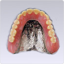総入れ歯　コバルトクロム義歯