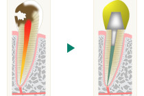 虫歯の治療　後期