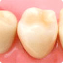 奥歯の被せ物　オールセラミック
