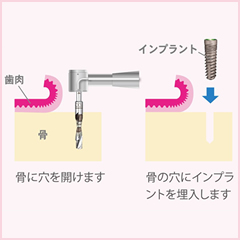 骨に穴を開けてインプラントを埋入します