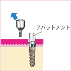 アバットメントに取り替えます