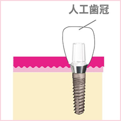 人工歯冠を作製し、装着します