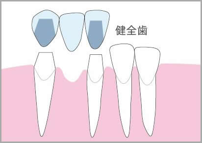 歯が中間で1本抜けた場合のブリッジによる治療