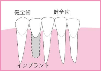 歯が中間で1本抜けた場合のインプラントによる治療