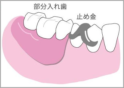 局部床義歯＝部分入れ歯による治療