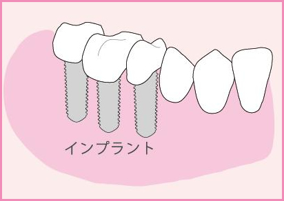 歯が中間で2本抜けた場合のインプラントによる治療