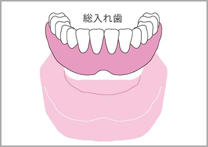 全部床義歯＝総入れ歯による治療
