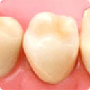 奥歯の詰め物　セラミック （メタルボンド）
