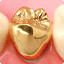 奥歯の被せ物　ゴールド（金）