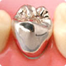 奥歯の被せ物　パラジウム（銀）