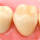 奥歯の被せ物　ジルコニア