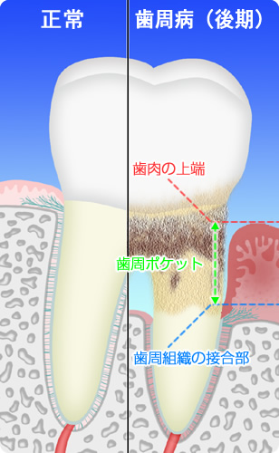 歯周病の状態